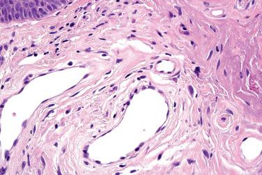 Fig. 2, Fibrous papule.