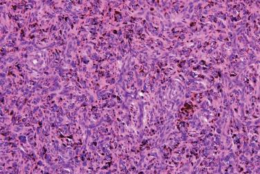 Fig. 14, Benign fibrous histiocytoma (dermatofibroma).