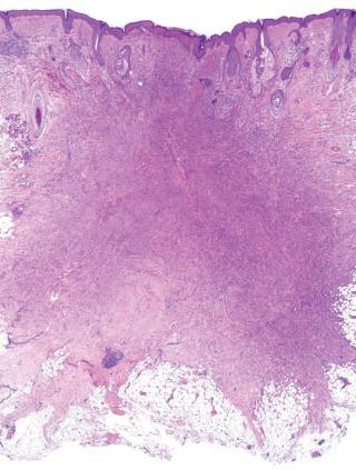 Fig. 1, Cellular fibrous histiocytoma.