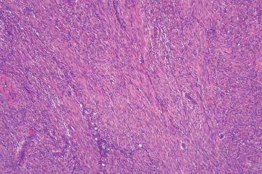 Fig. 3, Cellular fibrous histiocytoma.