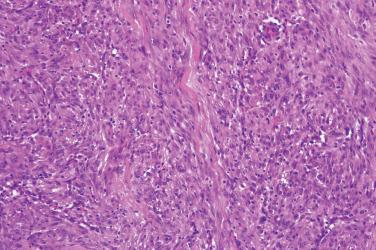 Fig. 4, Cellular fibrous histiocytoma.