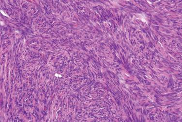 Fig. 5, Cellular fibrous histiocytoma