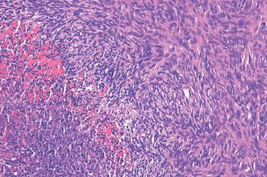 Fig. 6, Cellular fibrous histiocytoma.