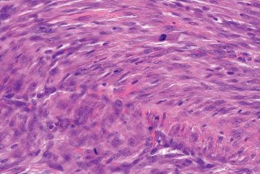 Fig. 7, Cellular fibrous histiocytoma.