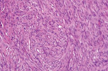 Fig. 9, Cellular fibrous histiocytoma.