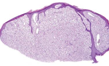 Fig. 3, Fibrous papule