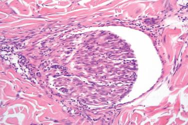 Fig. 10, Cellular fibrous histiocytoma.