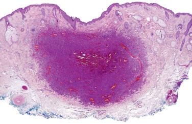 Fig. 1, Aneurysmal fibrous histiocytoma.