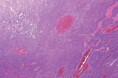 Fig. 2, Aneurysmal fibrous histiocytoma.