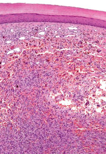 Fig. 4, Aneurysmal fibrous histiocytoma.