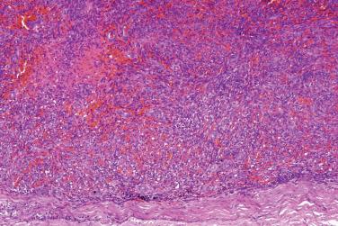 Fig. 5, Aneurysmal fibrous histiocytoma.