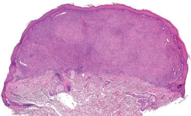 Fig. 1, Epithelioid fibrous histiocytoma.