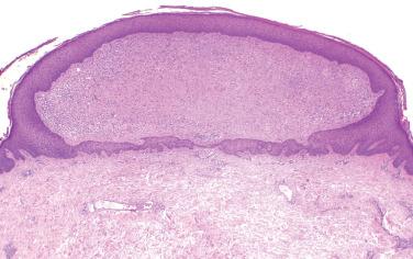 Fig. 2, Epithelioid fibrous histiocytoma.