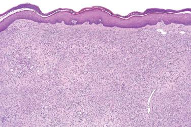 Fig. 3, Epithelioid fibrous histiocytoma.