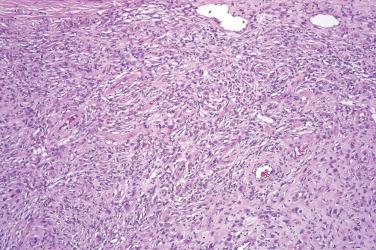 Fig. 4, Epithelioid fibrous histiocytoma.