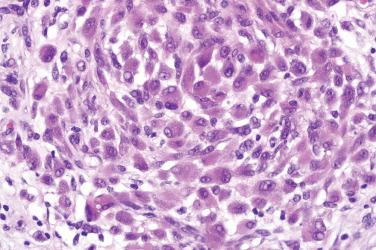 Fig. 5, Epithelioid fibrous histiocytoma.