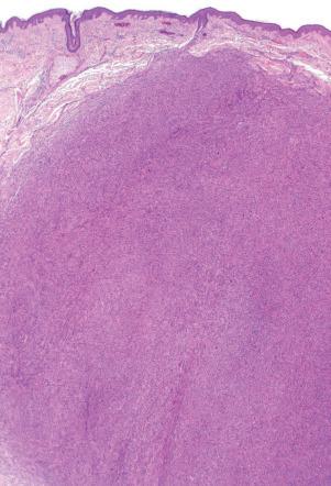 Fig. 1, Atypical (pseudosarcomatous) fibrous histiocytoma.