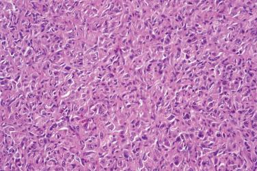 Fig. 3, Atypical fibrous histiocytoma.