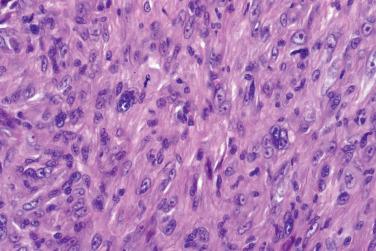 Fig. 4, Atypical (pseudosarcomatous) fibrous histiocytoma.