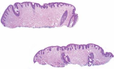 Fig. 1, Multinucleate cell angiohistiocytoma.