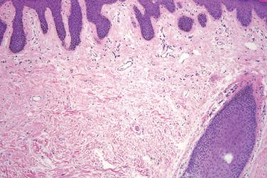 Fig. 2, Multinucleate cell angiohistiocytoma.