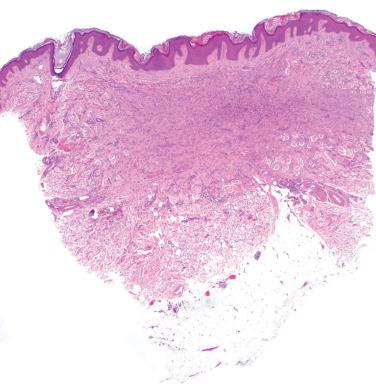 Fig. 1, Benign fibrous histiocytoma (dermatofibroma).