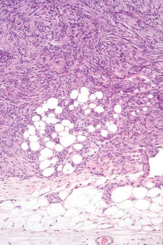 Fig. 3, Benign fibrous histiocytoma (dermatofibroma).