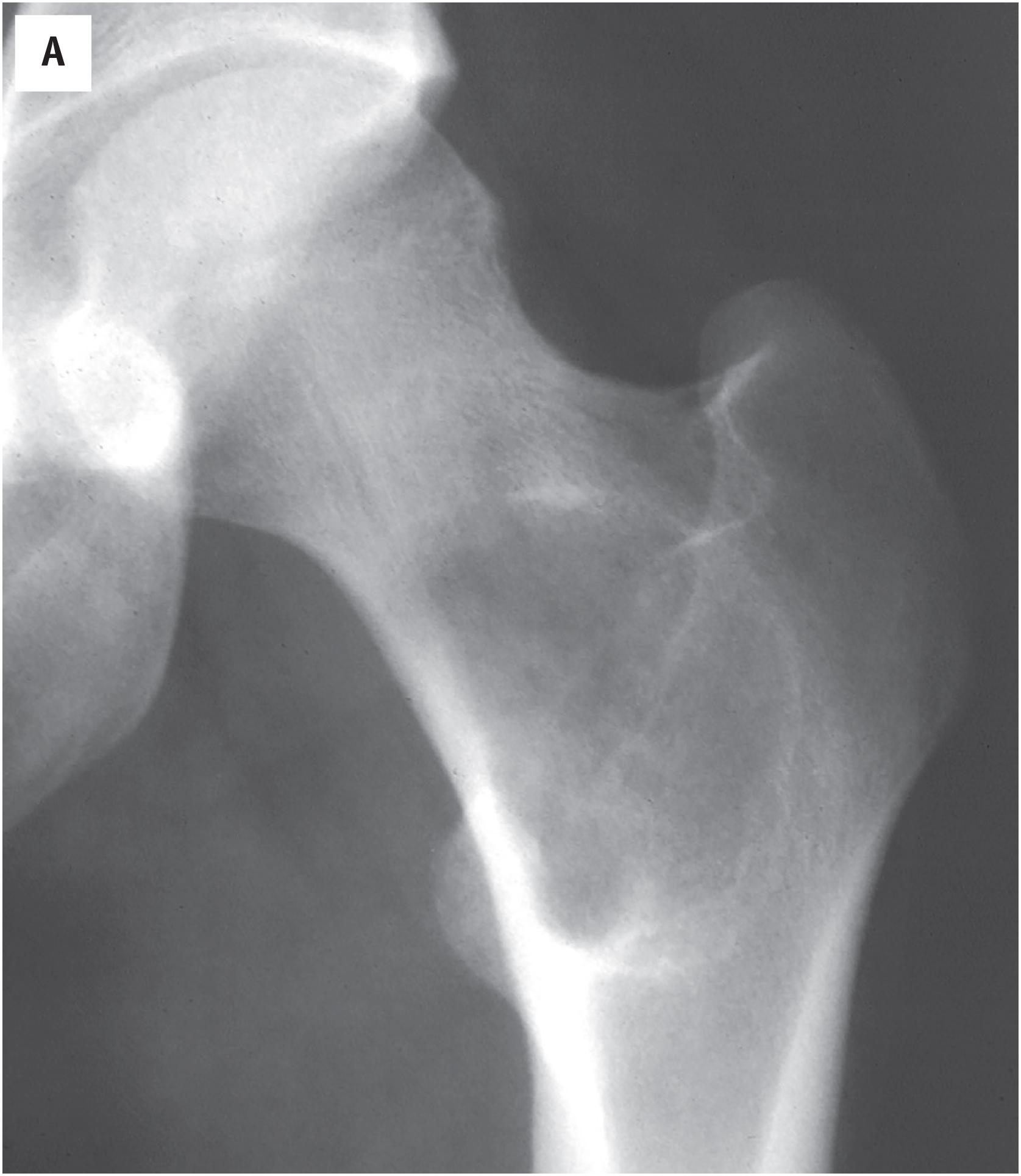 Fig. 24.1, (A), Fibrous dysplasia. Anteroposterior radiographs of the proximal femur demonstrate a well-demarcated lesion in the proximal femur. The margin of the lesion is sclerotic, and the lesion contains smudgy, “ground glass” appearance. (B), Fibrous dysplasia. An anteroposterior radiograph of the femur reveals a ground glass appearing lesion involving a large portion of the proximal femur, extending from the femoral neck to the diaphysis. (C), Fibrous dysplasia. The tumor is arising in the proximal radius. The bone is slightly “expanded”. The tumor is well demarcated and has a ground glass appearance. (D–E). Polyostotic fibrous dysplasia. A frontal radiograph of the femur demonstrates “shepherd’s crook deformity” in a patient with polyostotic fibrous dysplasia. A CT scan of the craniofacial skeleton shows diffuse involvement of the craniofacial bones.