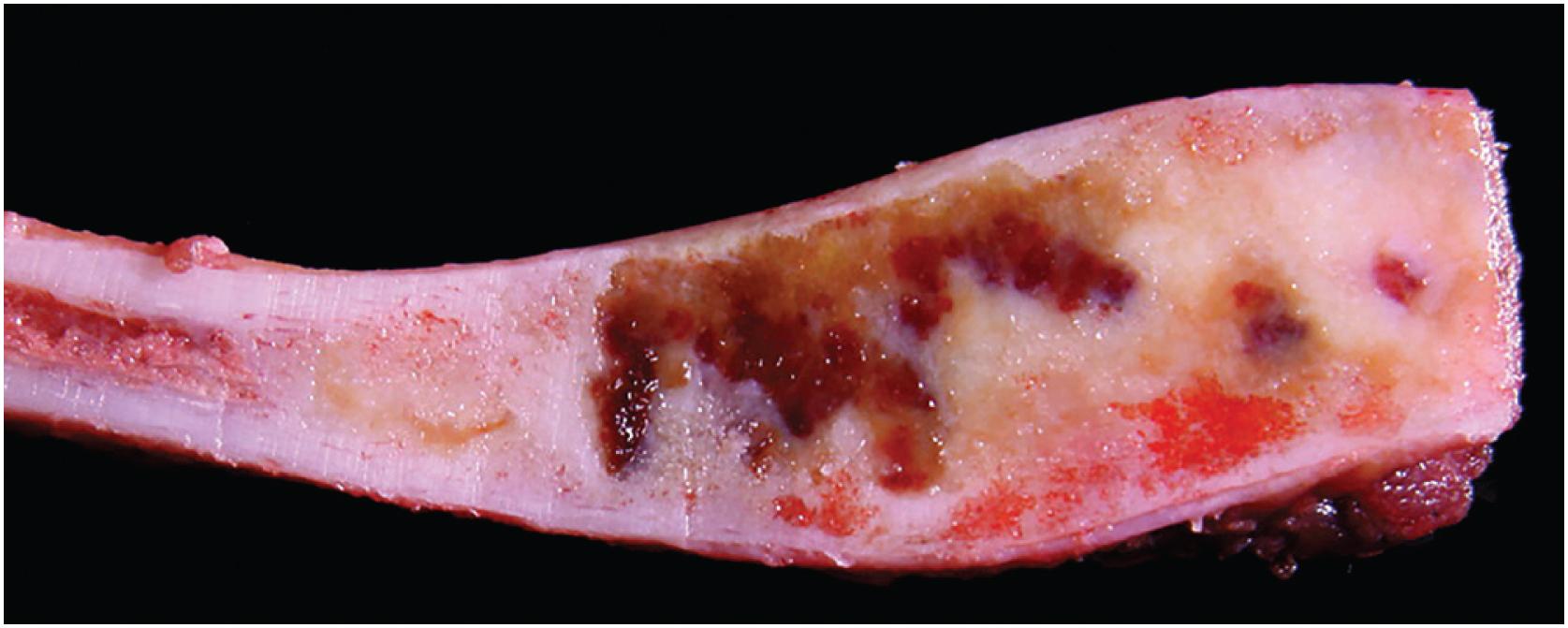 Fig. 24.2, Fibrous dysplasia of the rib. The tumor is solid and tan with cystic areas. It is well demarcated but has “expanded” the bone.