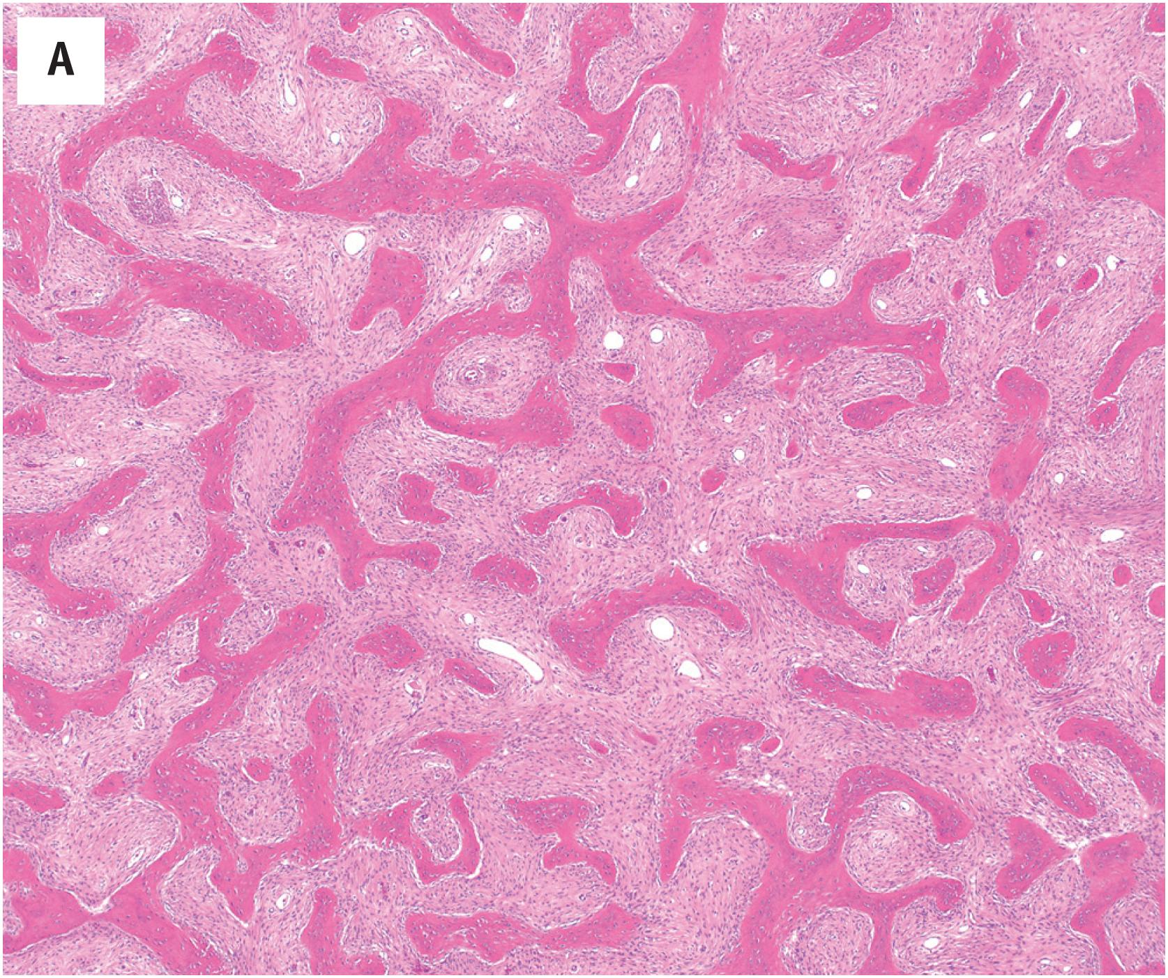 Fig. 24.3, Classic fibrous dysplasia comprised of spicules of woven bone, arranged in an alphabet-like pattern and emanating from a bland-appearing fibrous stroma (A). Higher power shows that the woven bone does not have a prominent osteoblastic rimming. Numerous collagen fibers emanate from the bone into the surrounding cellular fibrous stroma (B). Occasionally, the stroma may appear more cellular and sometimes accompanied by hemorrhage and osteoclast-type giant cells similar to what is seen in a solid aneurysmal bone cyst (C).