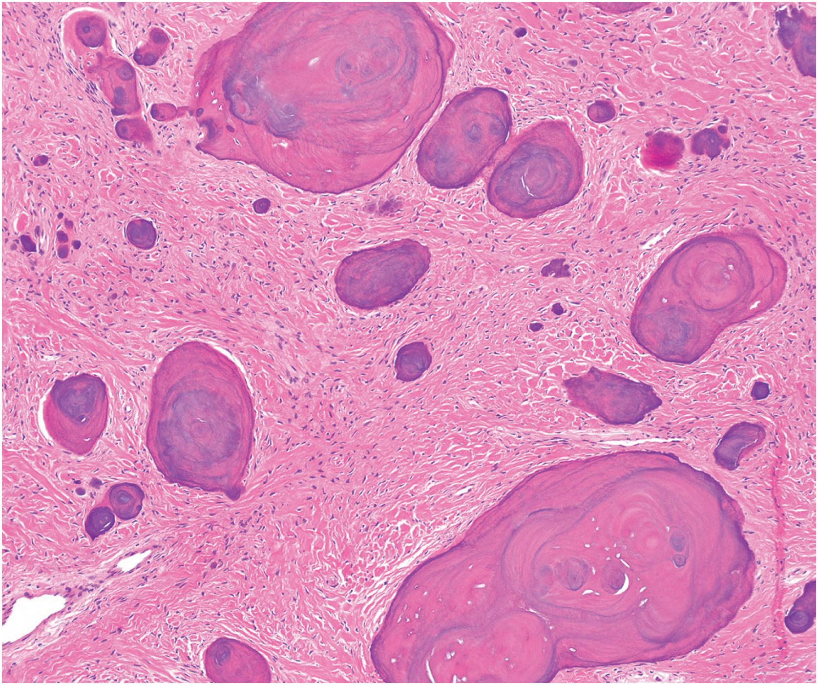 Fig. 24.4, Calcified sphericles (cementicles) are a common finding in fibrous dysplasia, especially within the craniofacial skeleton.