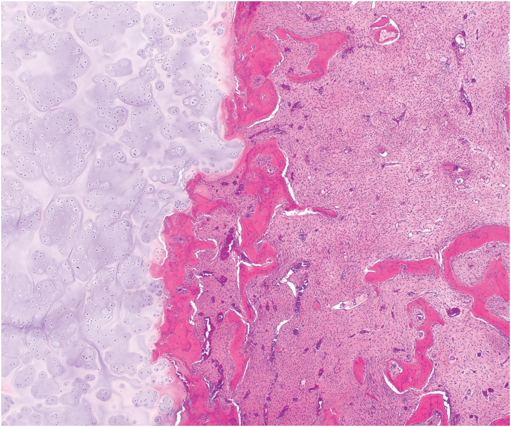 Fig. 24.5, Fibrous dysplasia is rarely associated with abundant hyaline cartilage production, fibrocartilaginous dysplasia.