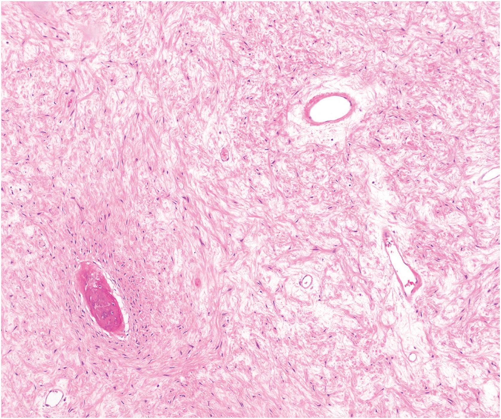 Fig. 24.6, The stroma of fibrous dysplasia ranges from the typical hypercellular to hypocellular and “bubbly” myxoid stroma. However, significant nuclear atypia is not observed.