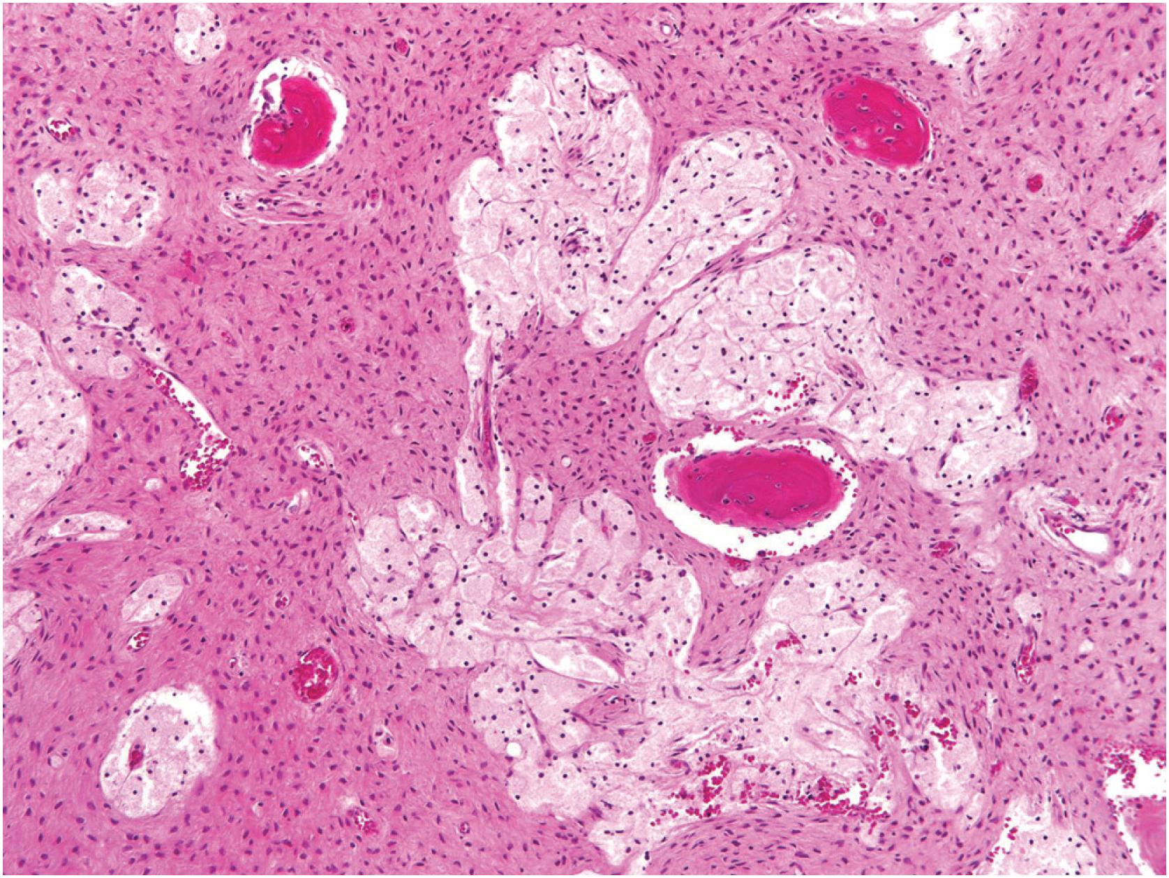 Fig. 24.7, Fibrous dysplasia with xanthomatous changes, including abundant foamy histiocytes.