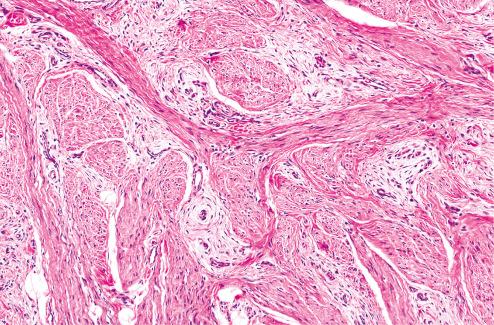 Fig. 8.3, Fibrous hamartoma of infancy with interlacing fibrous trabeculae and interspersed myxoid zones.