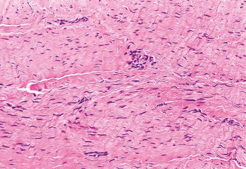 Fig. 8.11, Inclusion body fibromatosis, composed of a uniform proliferation of fibroblasts surrounded by a dense collagenous stroma.