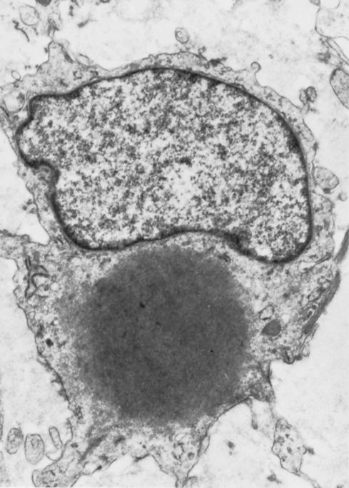 Fig. 8.13, Inclusion Body Fibromatosis.