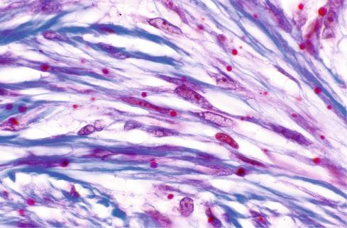 Fig. 8.14, Masson trichrome stain demonstrating characteristic intracytoplasmic inclusions characteristic of inclusion body fibromatosis.