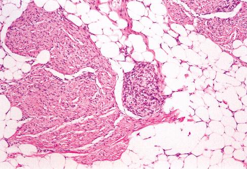 Fig. 8.5, Fibrous hamartoma of infancy showing admixture of mature adipose tissue, fibrous trabeculae, and a nodule of spindle-shaped cells.