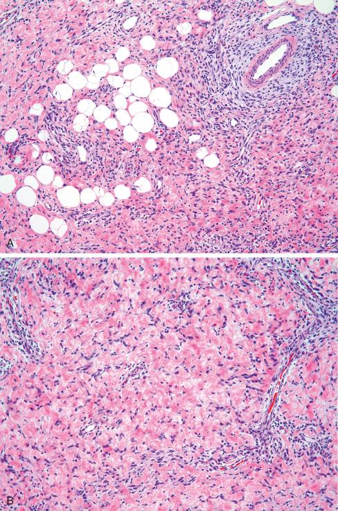 Fig. 8.8, Fibrous hamartoma ( A ) with giant cell fibroblastoma–like areas ( B and C ).