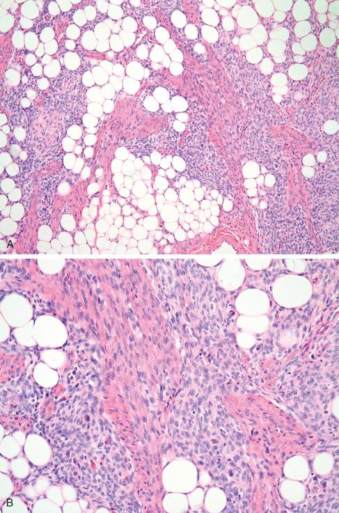 Fig. 8.9, Fibrous hamartoma with areas of sarcomatous transformation. Triphasic fibrous hamartoma ( A ) showing expansion of loose myxoid stroma by atypical cells ( B ) and adjacent sarcoma ( C ).