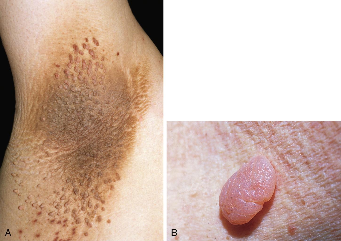 Fig. 42.1, A, Multiple, small, typical exophytic, light brown acrochordons of the axilla associated with acanthosis nigricans. B, Typical acrochordon demonstrating skin-colored, soft, pedunculated papule. Exophytic seborrheic keratoses and nevi may resemble acrochordons.