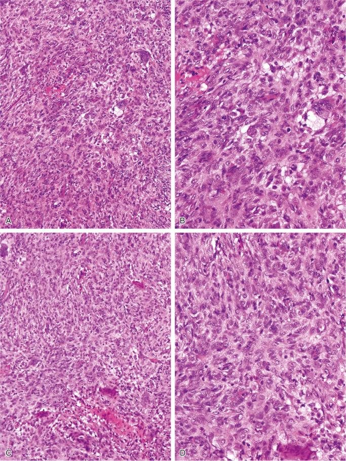 FIGURE 9-12, Nonossifying fibroma: microscopic features.