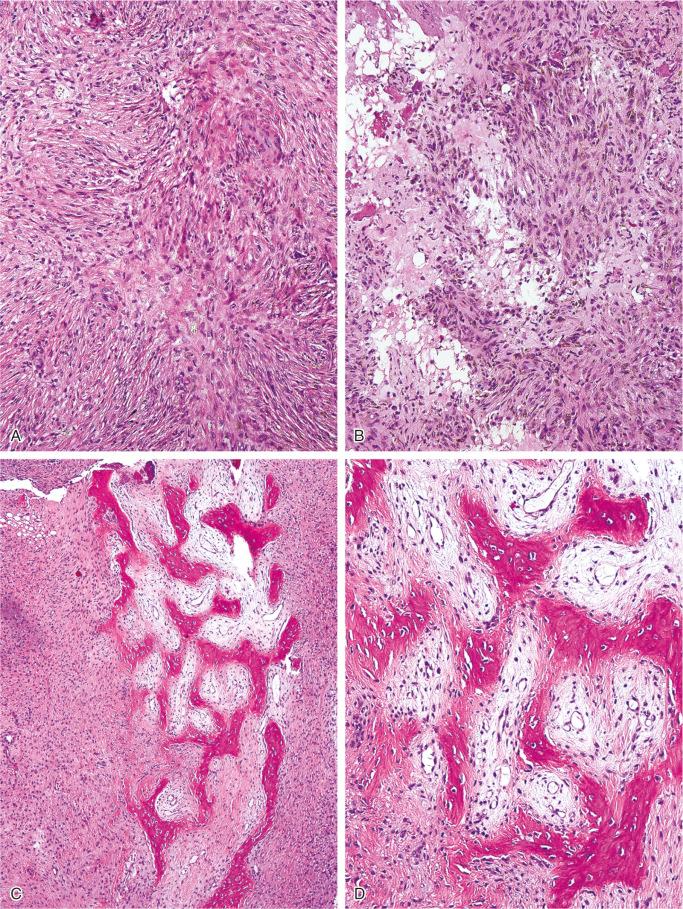 FIGURE 9-15, Nonossifying fibroma: microscopic features.