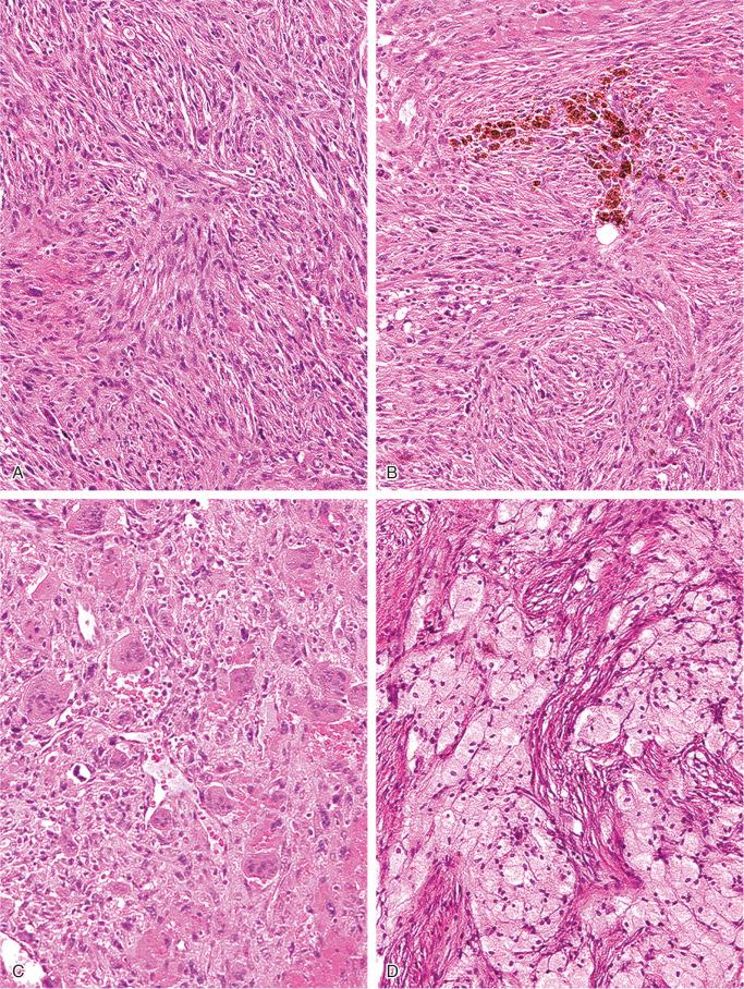 FIGURE 9-16, Nonossifying fibroma: microscopic features.