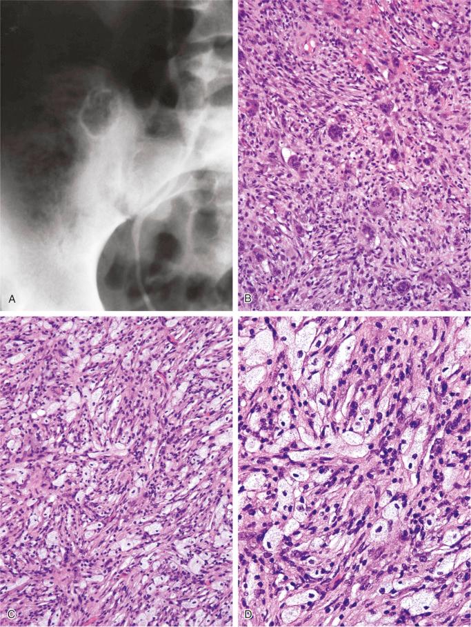 FIGURE 9-20, Benign fibrous histiocytoma (xanthofibroma) of bone: radiographic and microscopic features.