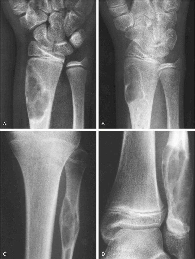 FIGURE 9-2, Nonossifying fibroma: radiographic features.