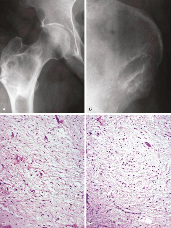 FIGURE 9-22, Fibromyxoma: radiographic and microscopic features.