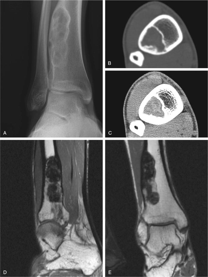 FIGURE 9-5, Nonossifying fibroma: radiographic features.