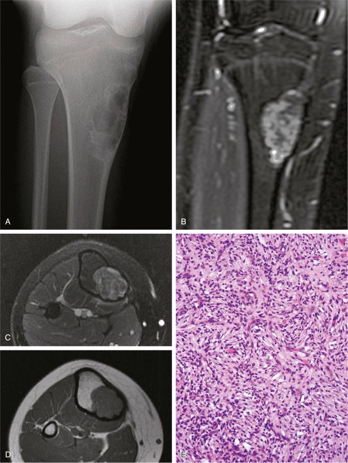 FIGURE 9-6, Nonossifying fibroma: radiographic and microscopic features.